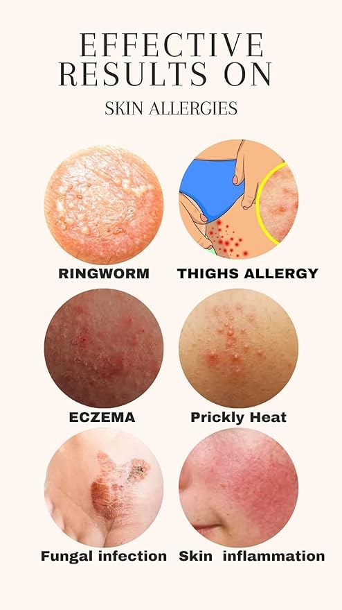 Al Arsh Allergy Cream (New Packing) Best For Fungal Infection Eczema Psoriasis Prickly Heat And Any Kind Of Skin Allergy 100% Results Guarantee Just Use It Once